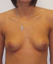 Breast Augmentation Silicone Implants Before and After | CIARAVINO Plastic Surgery