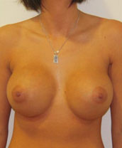 Breast Augmentation Silicone Implants Before and After | CIARAVINO Plastic Surgery