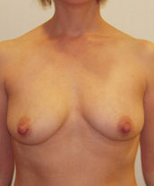 Breast Augmentation Silicone Implants Before and After | CIARAVINO Plastic Surgery