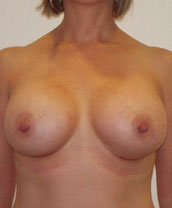 Breast Augmentation Silicone Implants Before and After | CIARAVINO Plastic Surgery