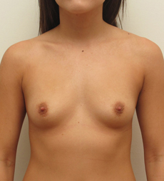 Breast Augmentation Silicone Implants Before and After | CIARAVINO Plastic Surgery