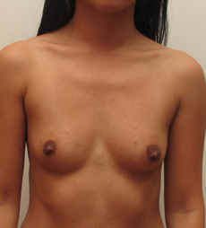 Breast Augmentation Silicone Implants Before and After | CIARAVINO Plastic Surgery