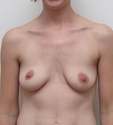 Breast Augmentation Silicone Implants Before and After | CIARAVINO Plastic Surgery