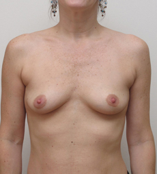 Breast Augmentation Silicone Implants Before and After | CIARAVINO Plastic Surgery