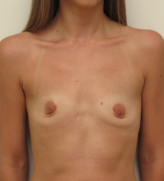 Breast Augmentation Silicone Implants Before and After | CIARAVINO Plastic Surgery