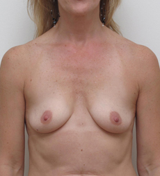 Breast Augmentation Silicone Implants Before and After | CIARAVINO Plastic Surgery