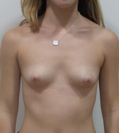 Breast Augmentation Silicone Implants Before and After | CIARAVINO Plastic Surgery