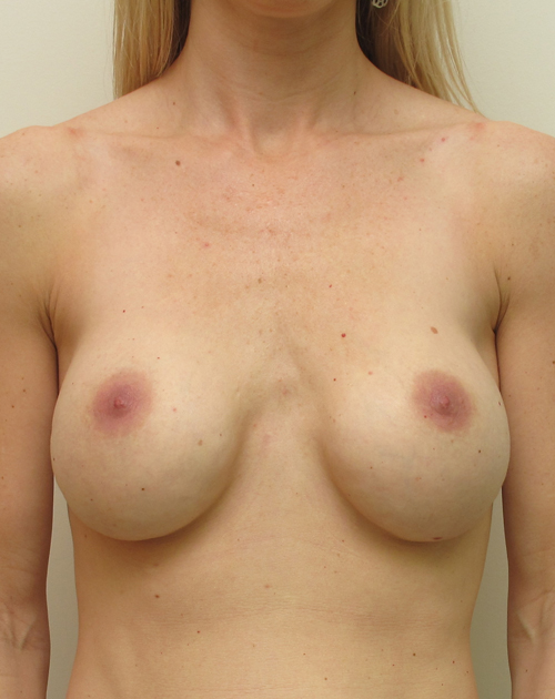 Breast Implant Revision Before and After | CIARAVINO Plastic Surgery