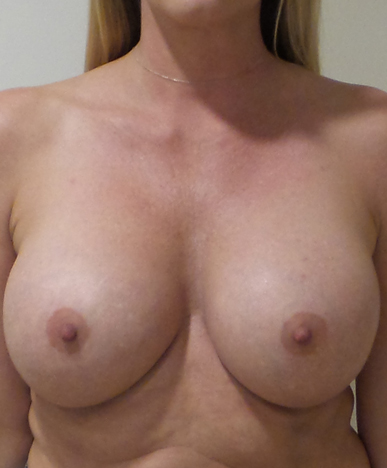 Breast Implant Revision Before and After | CIARAVINO Plastic Surgery