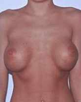 Breast Implant Revision Before and After | CIARAVINO Plastic Surgery