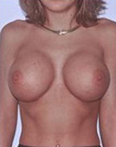 Breast Implant Revision Before and After | CIARAVINO Plastic Surgery