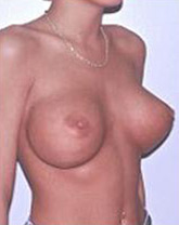 Breast Implant Revision Before and After | CIARAVINO Plastic Surgery