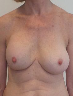 Breast Implant Revision Before and After | CIARAVINO Plastic Surgery