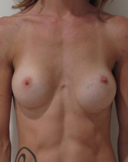 Breast Implant Revision Before and After | CIARAVINO Plastic Surgery