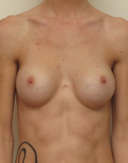 Breast Implant Revision Before and After | CIARAVINO Plastic Surgery