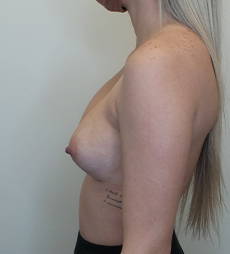 Breast Implant Revision Before and After | CIARAVINO Plastic Surgery