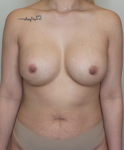 Breast Implant Revision Before and After | CIARAVINO Plastic Surgery