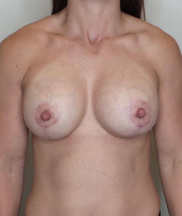 Breast Implant Revision Before and After | CIARAVINO Plastic Surgery