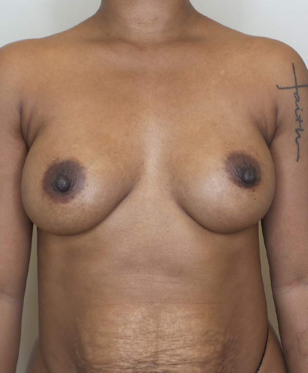 Breast Implant Revision Before and After | CIARAVINO Plastic Surgery