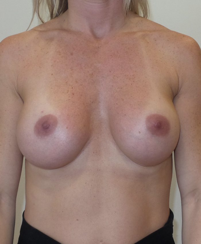 Breast Implant Revision Before and After | CIARAVINO Plastic Surgery