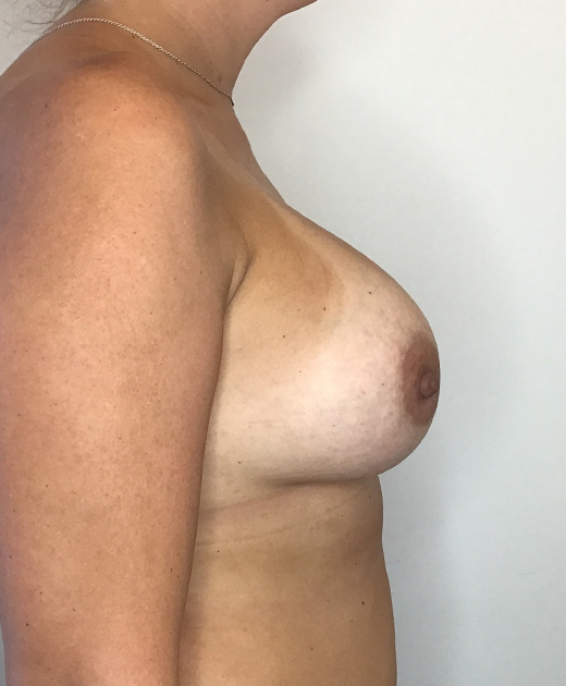 Breast Implant Revision Before and After | CIARAVINO Plastic Surgery