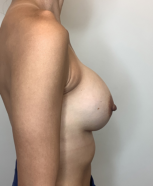 Breast Implant Revision Before and After | CIARAVINO Plastic Surgery