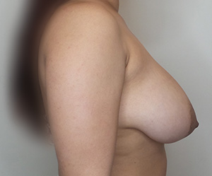 Breast Lift Mastopexy Before and After | CIARAVINO Plastic Surgery