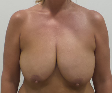 Breast Lift Mastopexy Before and After | CIARAVINO Plastic Surgery