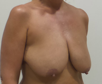 Breast Lift Mastopexy Before and After | CIARAVINO Plastic Surgery