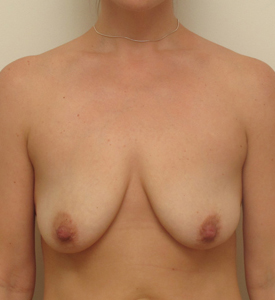 Breast Lift With Implants Before and After | CIARAVINO Plastic Surgery