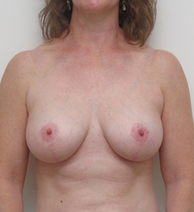 Breast Lift With Implants Before and After | CIARAVINO Plastic Surgery