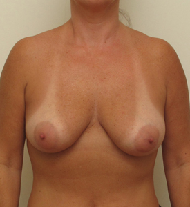 Breast Lift With Implants Before and After | CIARAVINO Plastic Surgery