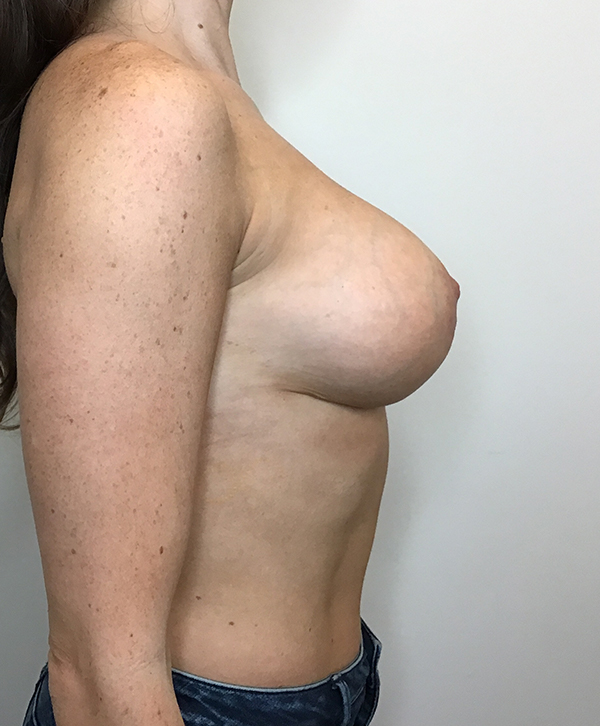 Breast Lift With Implants Before and After | CIARAVINO Plastic Surgery