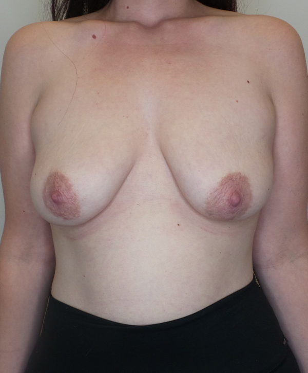 Breast Lift With Implants Before and After | CIARAVINO Plastic Surgery