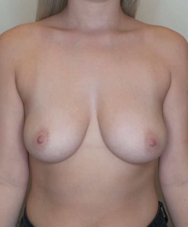 Breast Lift With Implants Before and After | CIARAVINO Plastic Surgery