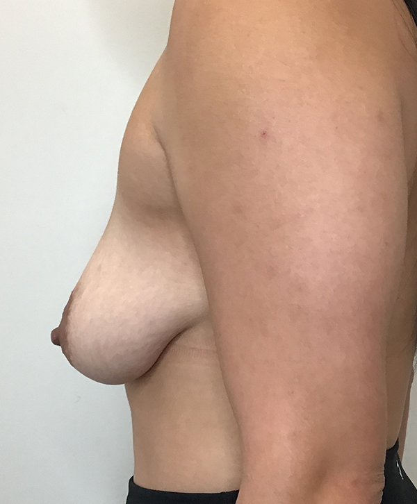 Breast Lift With Implants Before and After | CIARAVINO Plastic Surgery