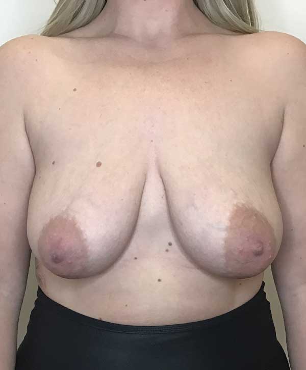 Breast Lift With Implants Before and After | CIARAVINO Plastic Surgery