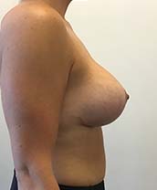 Breast Lift With Implants Before and After | CIARAVINO Plastic Surgery