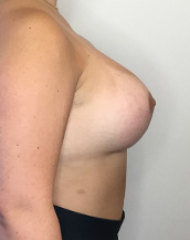 Breast Lift With Implants Before and After | CIARAVINO Plastic Surgery