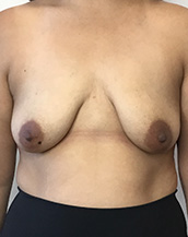 Breast Lift With Implants Before and After | CIARAVINO Plastic Surgery