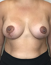 Breast Lift With Implants Before and After | CIARAVINO Plastic Surgery