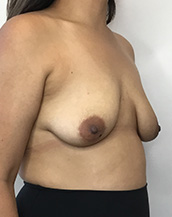 Breast Lift With Implants Before and After | CIARAVINO Plastic Surgery