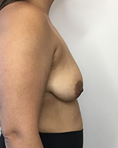 Breast Lift With Implants Before and After | CIARAVINO Plastic Surgery