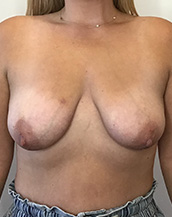 Breast Lift With Implants Before and After | CIARAVINO Plastic Surgery