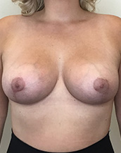 Breast Lift With Implants Before and After | CIARAVINO Plastic Surgery