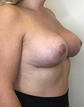 Breast Lift With Implants Before and After | CIARAVINO Plastic Surgery