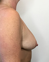 Breast Lift With Implants Before and After | CIARAVINO Plastic Surgery