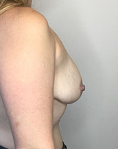 Breast Lift With Implants Before and After | CIARAVINO Plastic Surgery