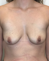 Breast Lift With Implants Before and After | CIARAVINO Plastic Surgery