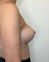 Breast Lift With Implants Before and After | CIARAVINO Plastic Surgery